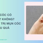 Mụn cóc có tự hết không? Cách điều trị mụn cóc hiệu quả nhất
