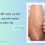 Viêm da tiếp xúc là gì? Dấu hiệu, nguyên nhân và cách điều trị