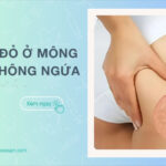 Nổi mẩn đỏ ở mông nhưng không ngứa là bệnh gì Cách điều trị hiệu quả