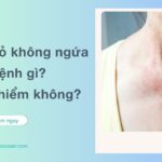 Nổi mẩn đỏ không ngứa là hiện tượng khá phổ biến và có thể xuất hiện do nhiều nguyên nhân khác nhau, từ phản ứng nhẹ của cơ thể đến dấu hiệu của các bệnh lý tiềm ẩn