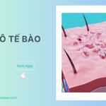 Viêm mô tế bào là bệnh lý nhiễm trùng thường do vi khuẩn gây ra