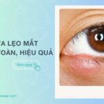 Mẹo chữa lẹo mắt cột chỉ an toàn, hiệu quả ngay tại nhà và các lưu ý