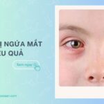 Càng dụi càng ngứa: Vì sao? Cách trị ngứa mắt hiệu quả