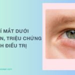 Sưng mí mắt dưới: Nguyên nhân, triệu chứng và cách điều trị