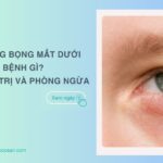 Trẻ bị sưng bọng mắt dưới là bệnh gì? Cách chữa trị và phòng ngừa