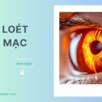 Viêm loét giác mạc: Nguyên nhân, triệu chứng và cách điều trị