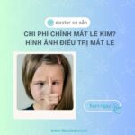 Chi phí chỉnh mắt lé kim? Hình ảnh điều trị mắt lé