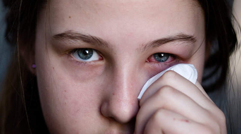 Đau mắt đỏ là tình trạng viêm lớp màng mỏng trong suốt bao phủ lòng trắng của mắt và mặt trong của mí mắt 