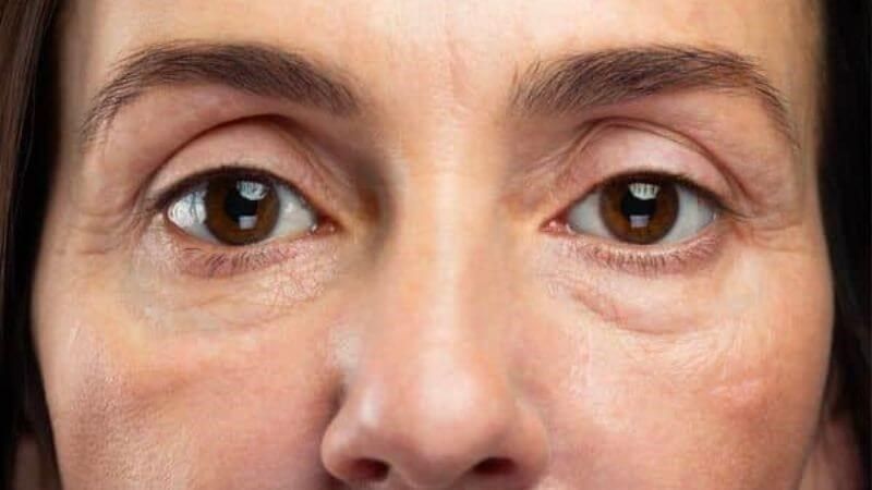 Mắt trũng, hay còn được gọi là hốc mắt sâu hoặc rãnh lệ, là tình trạng vùng da dưới mắt bị lõm xuống