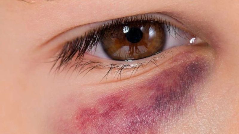 Các phương pháp không phẫu thuật có thể gây ra các tác dụng phụ tạm thời như sưng, bầm tím hoặc đỏ tại chỗ tiêm