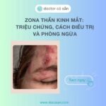 Zona thần kinh mắt: Triệu chứng, cách điều trị và phòng ngừa