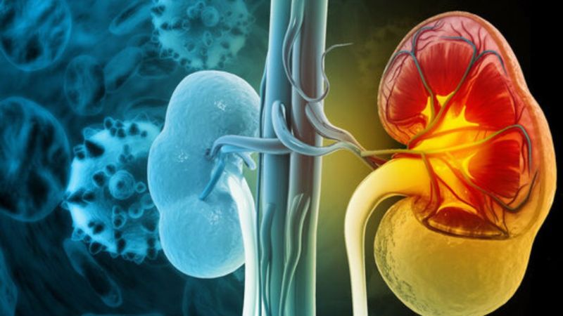 Suy thận là tình trạng một hoặc cả hai quả thận mất khả năng lọc máu hiệu quả