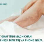 Suy giãn tĩnh mạch chân: Dấu hiệu, cách điều trị và phòng ngừa