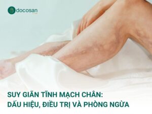 Suy giãn tĩnh mạch chân: Dấu hiệu, cách điều trị và phòng ngừa