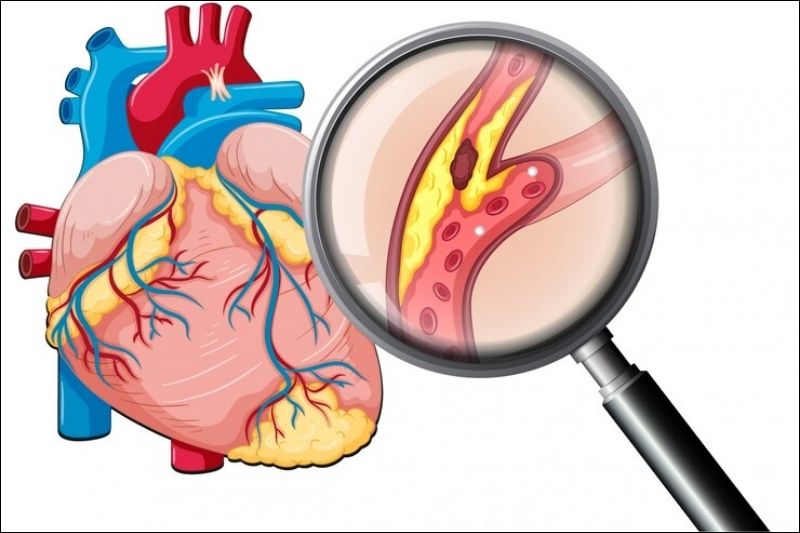 Sự hình thành mảng xơ vữa trong lòng động mạch tại tim