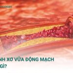 Bệnh xơ vữa động mạch là gì? Nguyên nhân, triệu chứng, cách điều trị