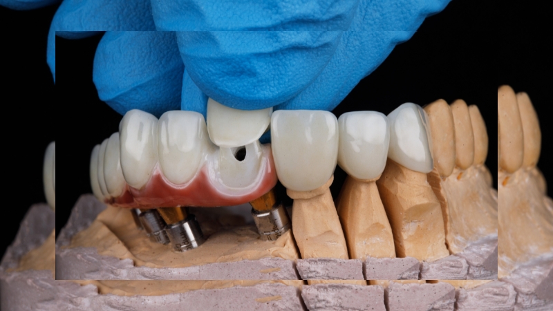 Nếu răng sứ bị ố vàng theo thời gian thì cách làm trắng răng sứ hiệu quả là thay răng sứ mới