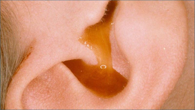 Tai chảy dịch là triệu chứng viêm tai giữa dễ nhận biết