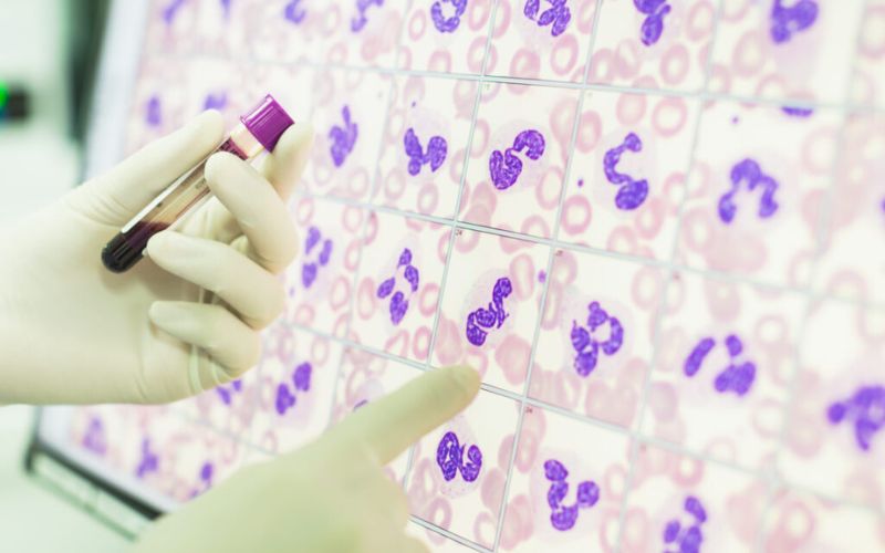 Chẩn Đoán Thiếu Máu: Xét Nghiệm và Phác Đồ Điều Trị Thiếu Sắt