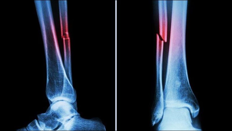 Gãy xương thường xảy ra khi có lực tác động mạnh như ngã, va đập, hoặc tiếp đất sai cách.