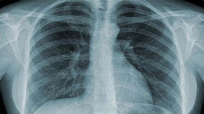Hình ảnh thu được sau khi chụp X quang phổi