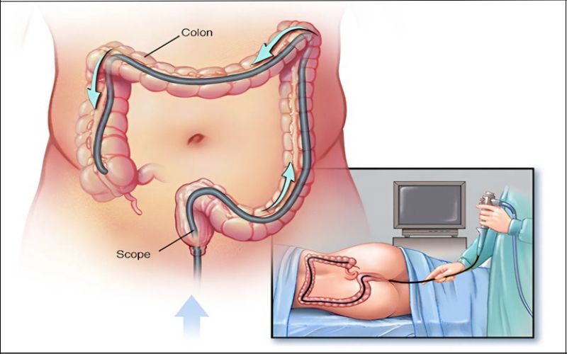 Nội soi đại tràng có thể phát hiện các bất thường như polyp, viêm loét, hoặc khối u gây cản trở lưu thông của phân