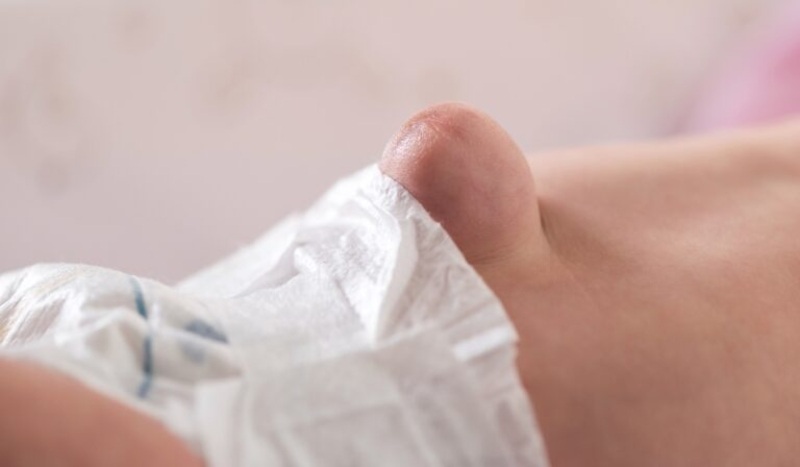 Bệnh thoát vị bẹn thường xuất hiện một khối phồng mềm ở vùng bẹn, có thể lan xuống bìu (ở bé trai) hoặc môi lớn (ở bé gái)