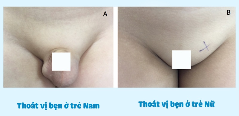 Phân biệt hình ảnh thoát vị bẹn ở bé trai và bé gái giúp phụ huynh nhận diện rõ hơn