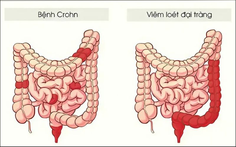 Viêm loét đại tràng và bệnh Crohn cũng gây tình trạng đau bụng không đi ngoài được