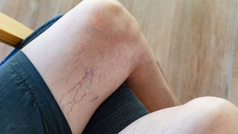 Thời gian điều trị suy giãn tĩnh mạch rất khác nhau tùy thuộc vào phương pháp điều trị được lựa chọn và mức độ nghiêm trọng của bệnh