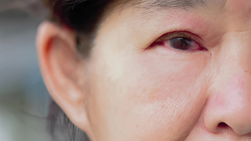 Glaucoma góc mở và góc đóng là hai loại phổ biến, thường gặp