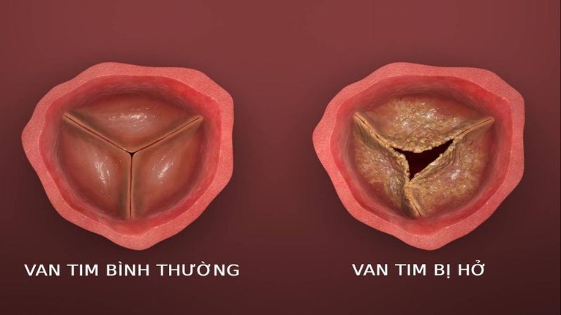 Mức độ và phương pháp điều trị sẽ phụ thuộc vào tình trạng cụ thể của từng người bệnh