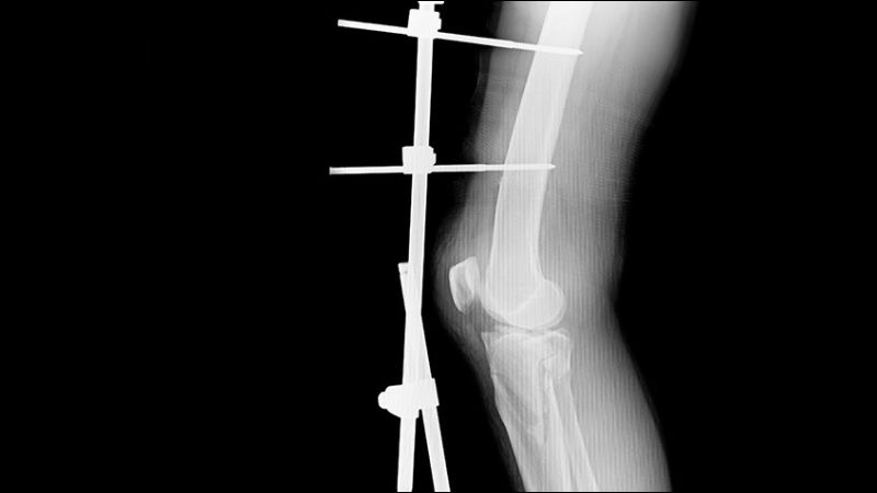 Phẫu thuật kết hợp xương giúp bệnh nhân liền xương nhanh chóng