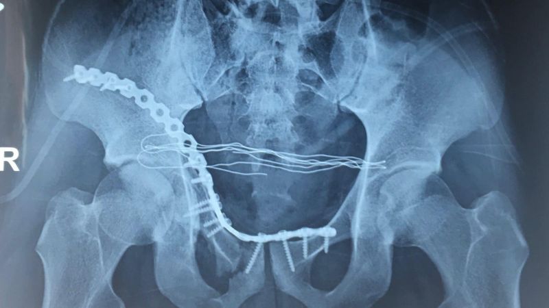 Phẫu thuật kết hợp xương được chỉ định trong các trường hợp gãy xương nghiêm trọng