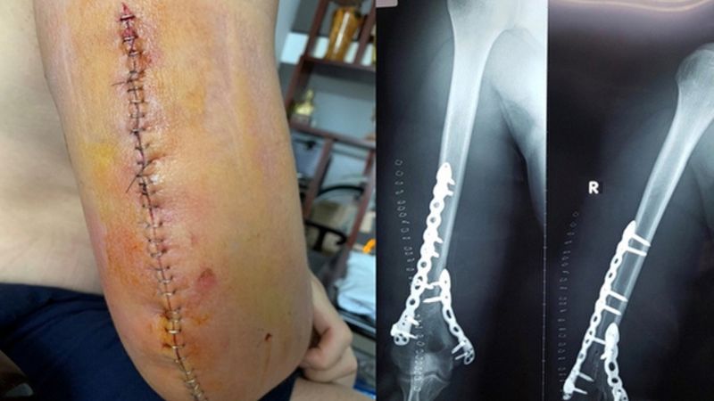 Cơn đau do vết mổ thường giảm dần và không quá 3 ngày