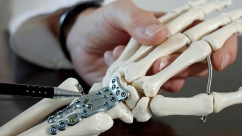 Có 2 phương pháp phẫu thuật kết hợp xương phổ biến