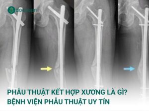 Phẫu thuật kết hợp xương là gì? Bệnh viện phẫu thuật uy tín