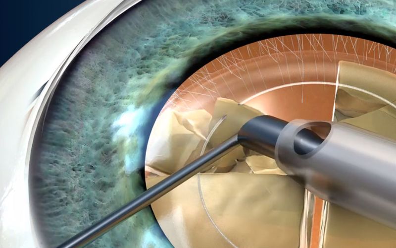 Phẫu thuật Phaco: Địa chỉ phẫu thuật phaco uy tín tại Quảng Nam