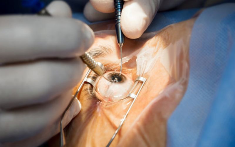 Phẫu thuật Phaco: Địa chỉ phẫu thuật phaco uy tín tại Quảng Nam