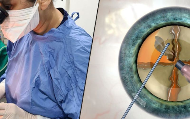 Phẫu thuật Phaco: Địa chỉ phẫu thuật phaco uy tín tại Quảng Nam