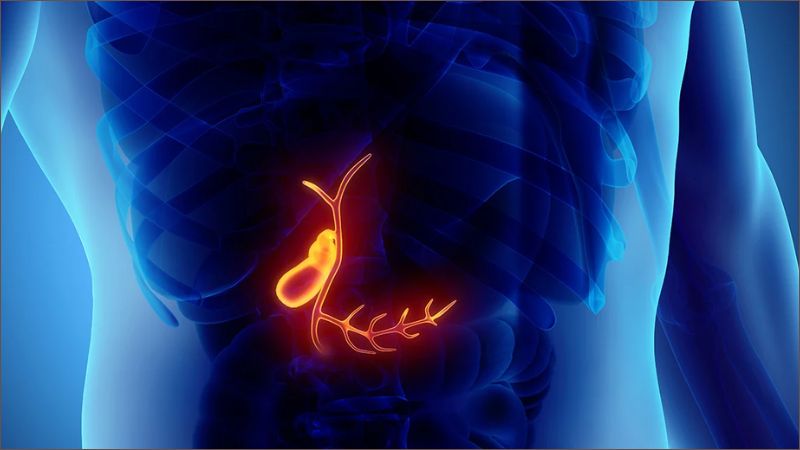 Sỏi mật là những viên sỏi nhỏ, cứng được hình thành trong một cơ quan nhỏ nằm bên dưới gan gọi là túi mật