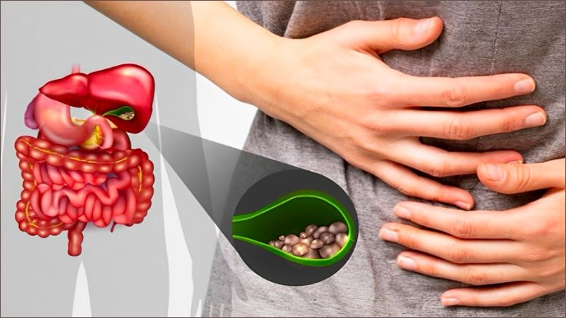 Sỏi mật chủ yếu là do lượng cholesterol ở trong dịch mật gia tăng quá mức, vượt quá khả năng hòa tan của muối mật