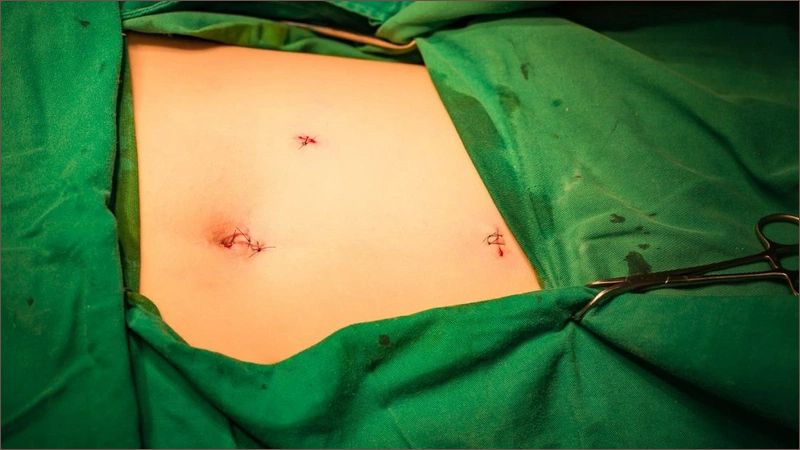 Phẫu thuật cắt túi mật là phương pháp điều trị dứt điểm sỏi mật