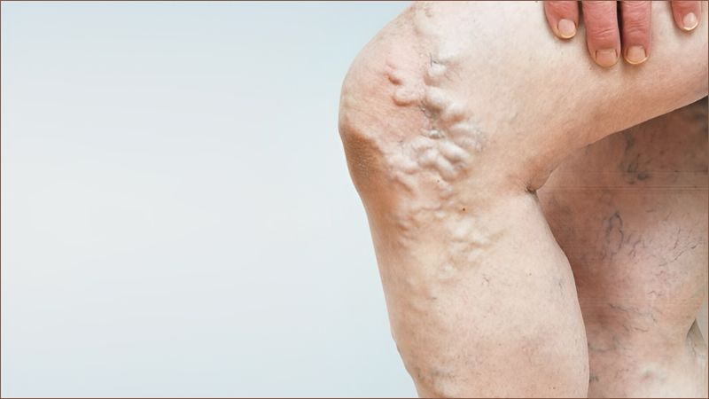 Suy giãn tĩnh mạch chân thường khởi phát do hai nhóm nguyên nhân chính là suy tĩnh mạch tiên phát và suy tĩnh mạch thứ phát