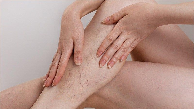 Suy giãn tĩnh mạch chân ở giai đoạn đầu thường không biểu hiện rõ ràng trên bề mặt da