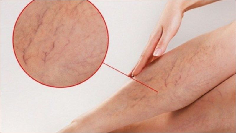 Bệnh có thể tiến triển đến các giai đoạn nặng hơn với các triệu chứng như phù chân, thay đổi màu sắc da, tĩnh mạch nổi rõ