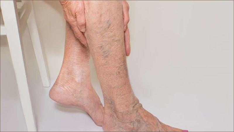 Suy giãn tĩnh mạch chân ở giai đoạn này có thể quan sát rõ hơn dưới da, các tĩnh mạch bắt đầu giãn ra