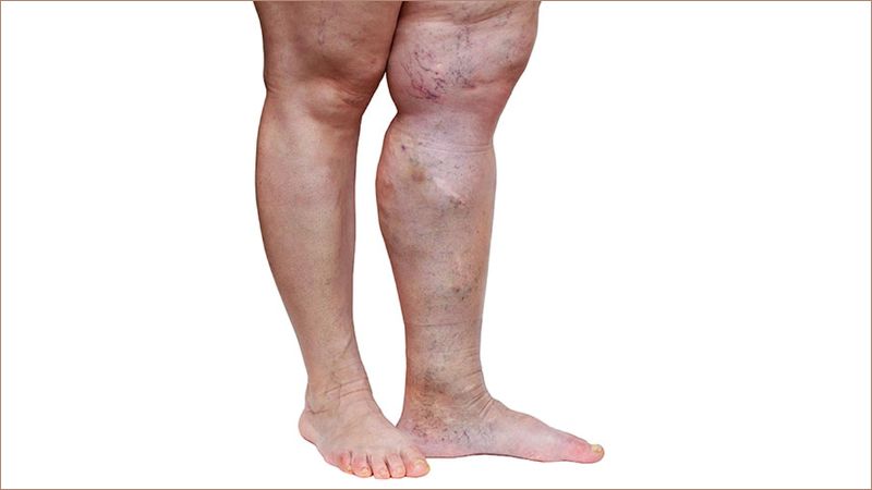 Sưng và phù chân do suy giãn tĩnh mạch kéo dài
