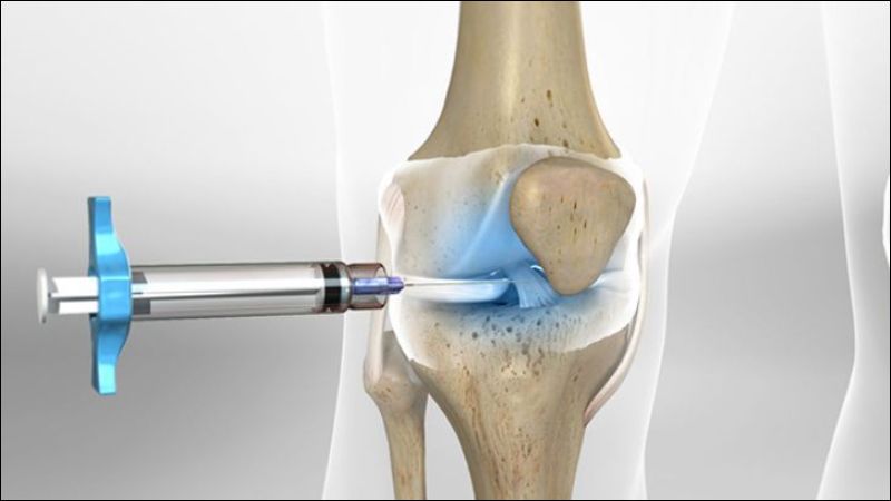 Phương pháp tiêm PRP có khả năng giảm đau, tái tạo mô và ít xâm lấn tuy nhiên hiệu quả tùy vào từng bệnh nhân khác nhau nên cần cân nhắc trước khi điều trị
