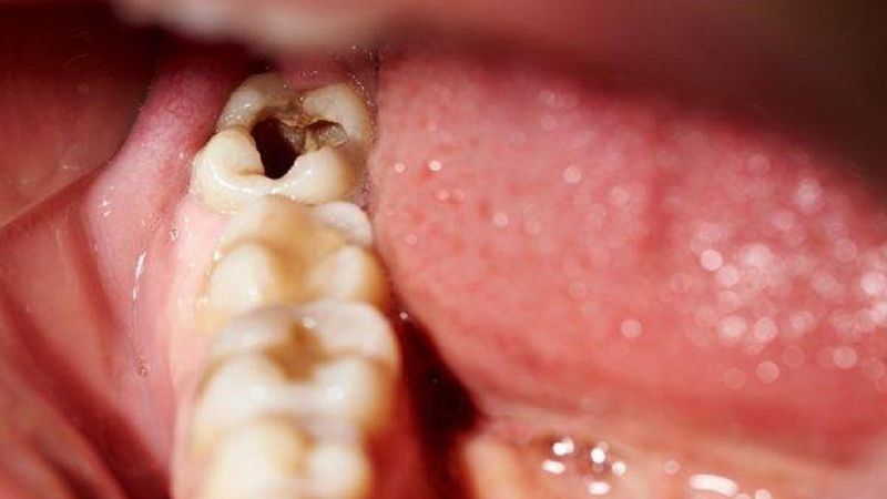 Sâu răng là tình trạng vi khuẩn tấn công và tàn phá men răng, tạo thành các lỗ sâu